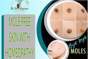 Best Mole Removal with Homeopathy in Ghaziabad