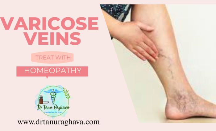 VARICOSE VEINS