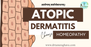 atopic dermatitis