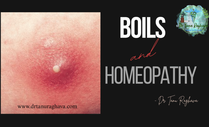 Homeopathic treatment of boils