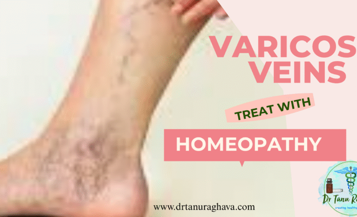 varicose veins and homeopathy