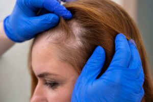 Best Hair Fall Treatment in Indirapuram