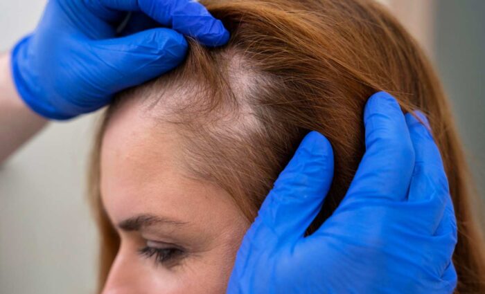 Best Hair Fall Treatment in Indirapuram