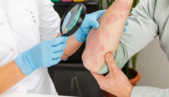 Skin Diseases Treatment in Indirapuram