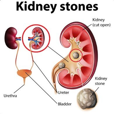 Kidney Stone Treatment in Vaishali